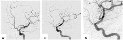 Flow Diverter-Assisted Coil Embolization of Blood Blister-Like Aneurysm Using Semi-deploying Technique